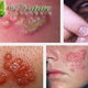 Illustration for article titled Obat Herpes Herbal